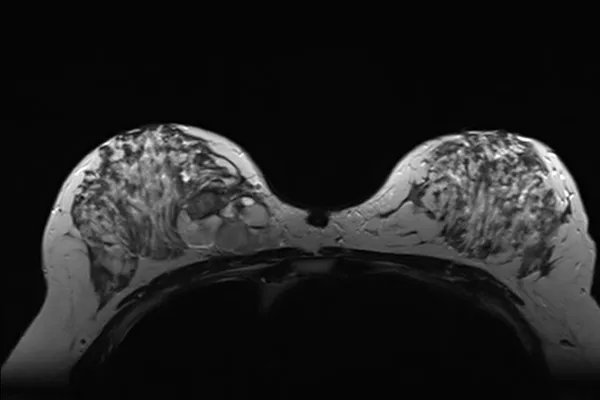 mammo-imaging
